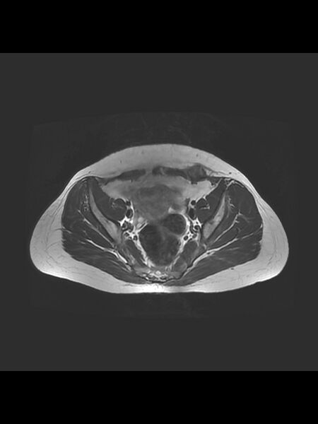 File:Cesarean section scar endometrioma (Radiopaedia 56569-63297 Axial T2 11).jpg