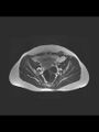 Cesarean section scar endometrioma (Radiopaedia 56569-63297 Axial T2 11).jpg