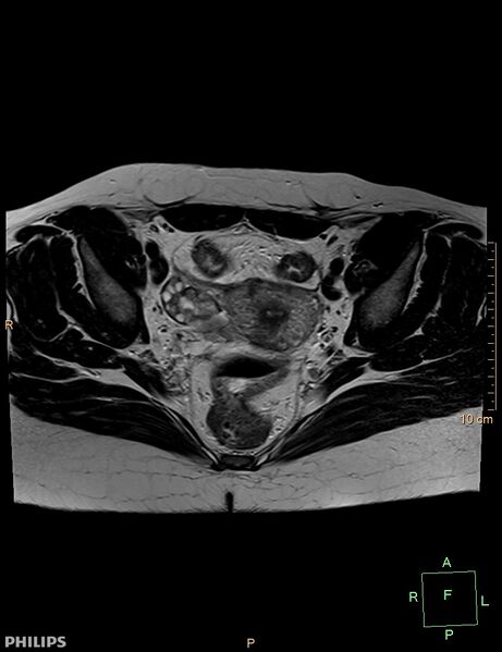 File:Cesarian scar endometriosis (Radiopaedia 68495-78066 Axial T2 13).jpg