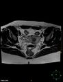 Cesarian scar endometriosis (Radiopaedia 68495-78066 Axial T2 13).jpg