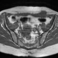 Cesarian section scar endometriosis (Radiopaedia 66520-75799 Axial T1 6).jpg