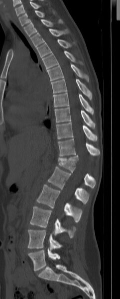 File:Chance fracture (Radiopaedia 45345-49372 Sagittal bone window 11).jpg