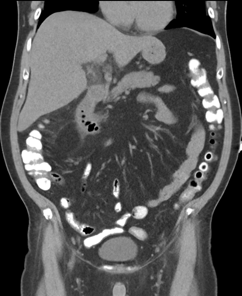 File:Cholecystitis with focal perforation and hepatic abscess (Radiopaedia 37189-38945 Coronal non-contrast 24).png