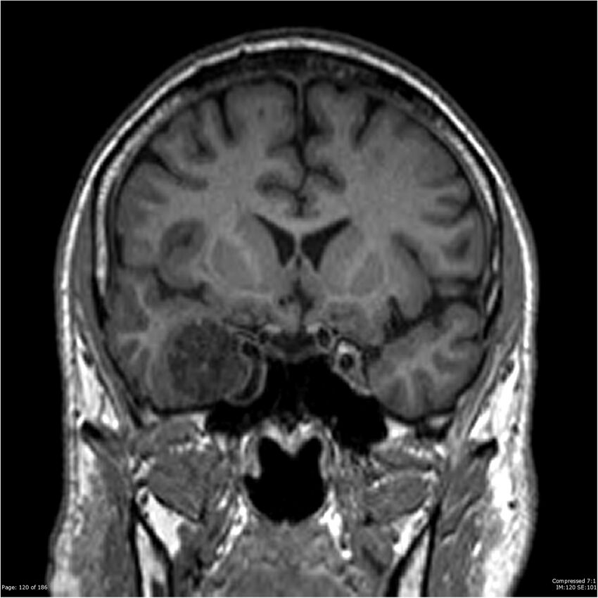 Chondrosarcoma of skull base- grade II (Radiopaedia 40948-43654 Coronal T1 41).jpg
