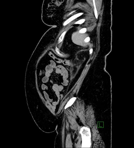File:Chromophobe renal cell carcinoma (Radiopaedia 84239-99519 G 20).jpg