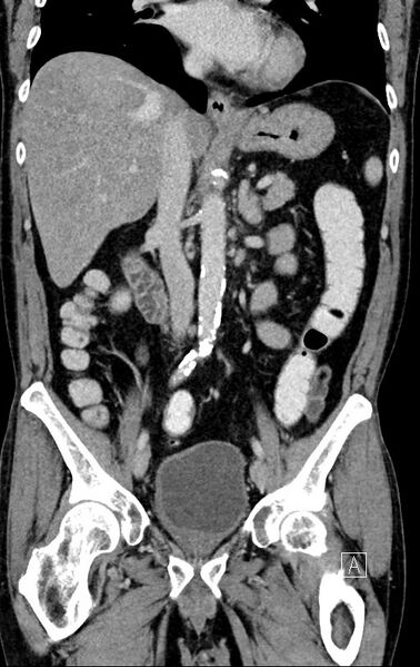 File:Chronic appendicitis complicated by appendicular abscess, pylephlebitis and liver abscess (Radiopaedia 54483-60700 C 42).jpg