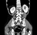 Chronic pancreatitis (Radiopaedia 23132-23172 C 46).jpg