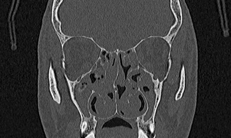 File:Chronic rhinosinusitis (Radiopaedia 65079-74075 Coronal bone window 40).jpg