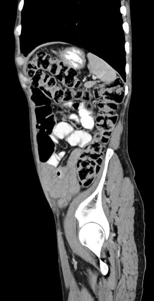 File:Chronic small bowel volvulus (Radiopaedia 75224-86322 C 35).jpg