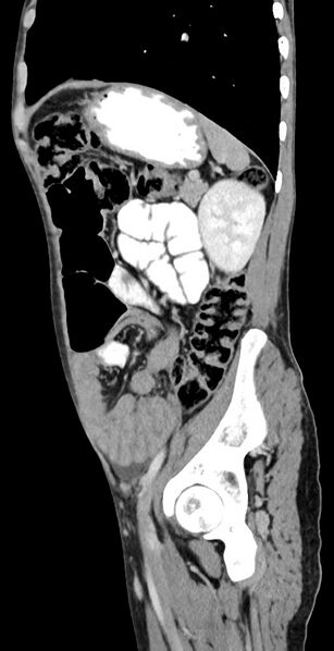 File:Chronic small bowel volvulus (Radiopaedia 75224-86322 C 44).jpg