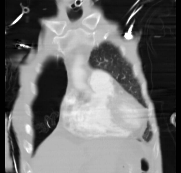 File:Clagett thoracotomy with bronchopleural fistula (Radiopaedia 29192-29587 Coronal lung window 25).jpg