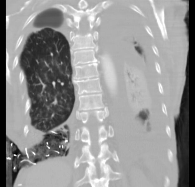 File:Clagett thoracotomy with bronchopleural fistula (Radiopaedia 29192-29587 Coronal lung window 6).jpg