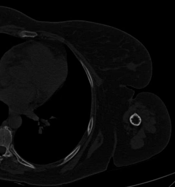 File:Clear cell chondrosarcoma - humerus (Radiopaedia 63104-71612 Axial bone window 98).jpg