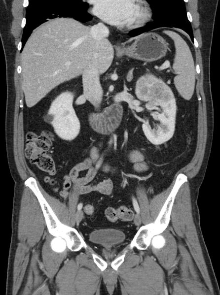File:Clear cell renal cell carcinoma (Radiopaedia 61449-69393 F 15).jpg