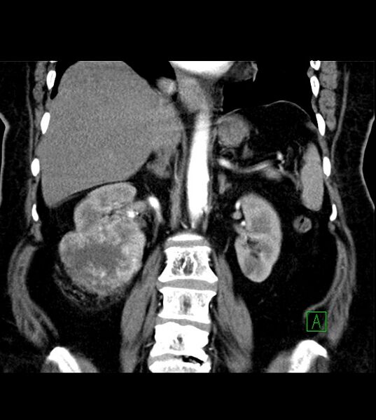 File:Clear cell renal cell carcinoma (Radiopaedia 85004-100537 C 30).jpg