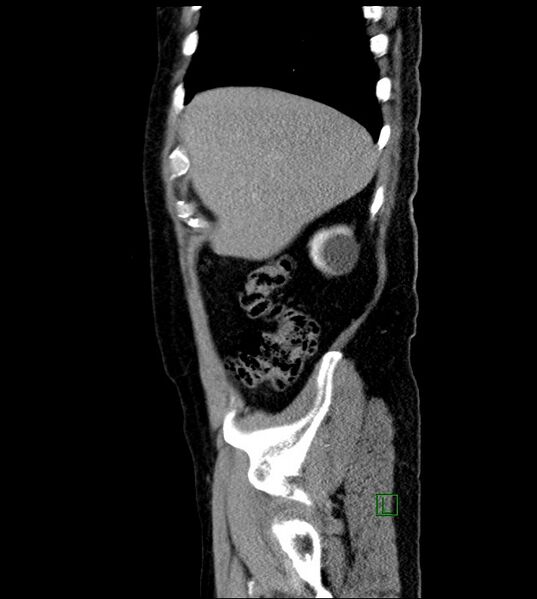 File:Clear cell renal cell carcinoma (Radiopaedia 85006-100539 E 51).jpg