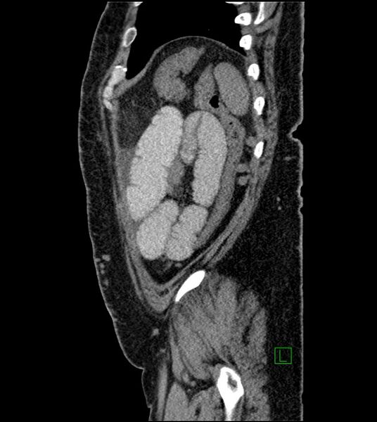 File:Closed-loop small bowel obstruction-internal hernia (Radiopaedia 78439-91096 C 29).jpg