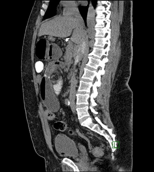 File:Closed-loop small bowel obstruction-internal hernia (Radiopaedia 78439-91096 C 81).jpg