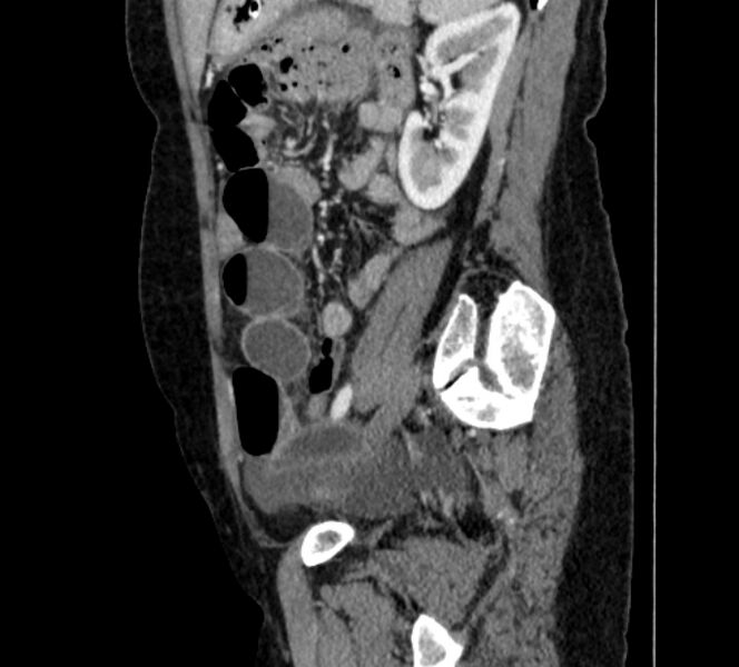 File:Closed loop small bowel obstruction (Radiopaedia 71211-81508 C 114).jpg