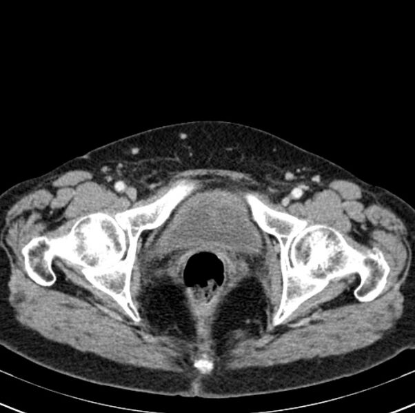 File:Colon carcinoma with hepatic metastases (Radiopaedia 29477-29961 A 111).jpg