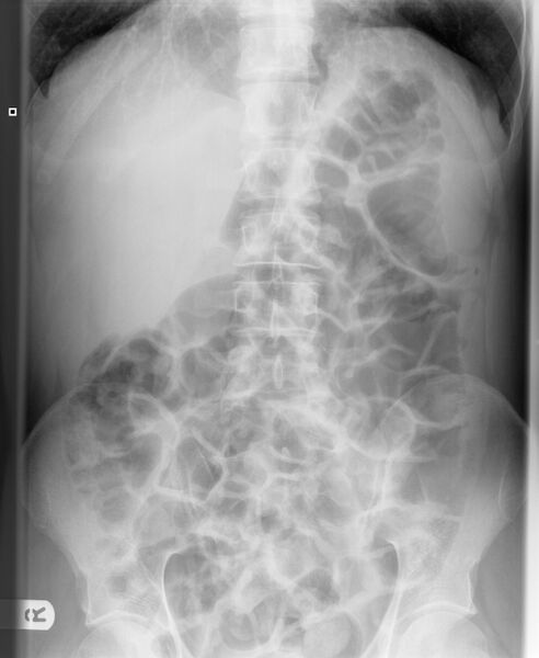 File:Hepatomegaly (abdominal x-ray) (Radiopaedia 6214).jpg