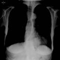 Nasogastric tube in hiatus hernia (Radiopaedia 6146-7613 B 1).jpg