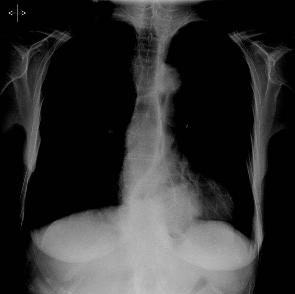 File:Nasogastric tube in hiatus hernia (Radiopaedia 6146-7613 B 1).jpg