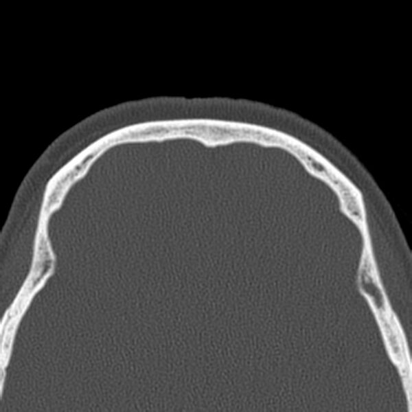 File:Nasolabial cyst (Radiopaedia 33987-35205 Axial bone window 46).jpg