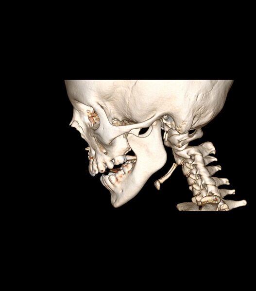 File:Nasoorbitoethmoid fracture (Radiopaedia 90044-107205 3D VRT 35).jpg