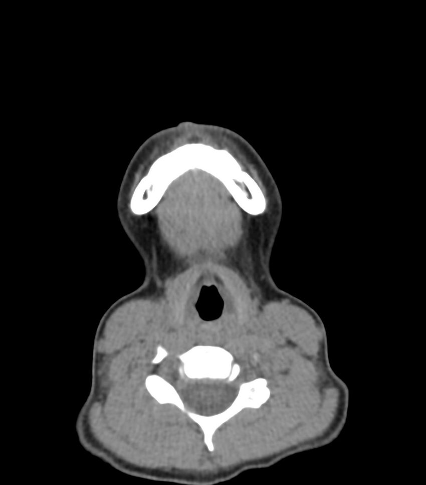 Nasoorbitoethmoid fracture (Radiopaedia 90044-107205 Axial non-contrast 33).jpg