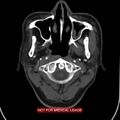 Nasopharyngeal carcinoma recurrence - skull base destruction (Radiopaedia 29107-29491 A 12).jpg