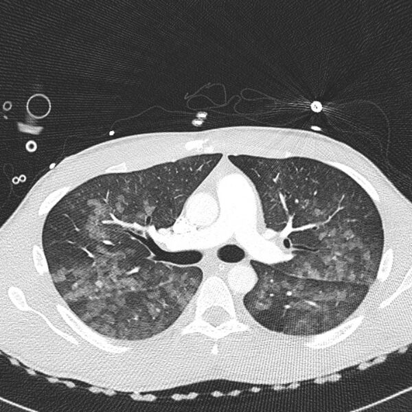 File:Near drowning (pulmonary edema) (Radiopaedia 24685-24958 lung window 16).jpg