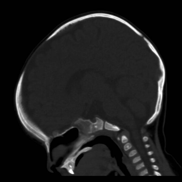 File:Neuroblastoma with skull metastases (Radiopaedia 30326-30958 Sagittal bone window 20).jpg