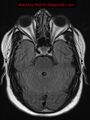Neuroglial cyst (Radiopaedia 10713-11184 Axial FLAIR 16).jpg