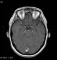 Neurosarcoidosis (Radiopaedia 10930-11351 Axial T1 C+ 7).jpg