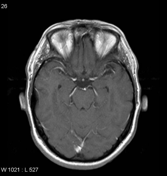 File:Neurosarcoidosis (Radiopaedia 10930-11351 Axial T1 C+ 7).jpg