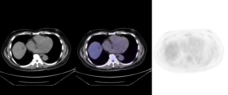 File:Non-Hodgkin lymphoma involving seminal vesicles with development of interstitial pneumonitis during Rituximab therapy (Radiopaedia 32703-33752 ax CT Fus PET 26).jpg