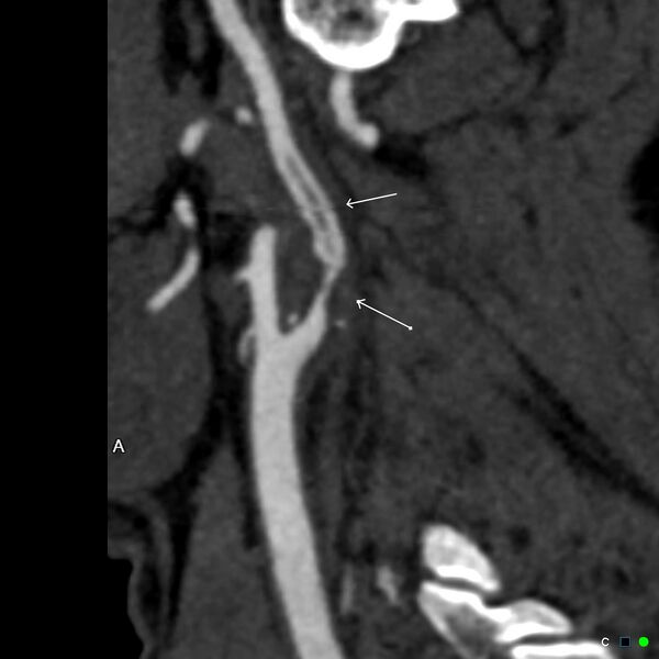 File:Non-occlusive intraluminal internal carotid artery thrombus (Radiopaedia 37751-39658 A 56).jpg