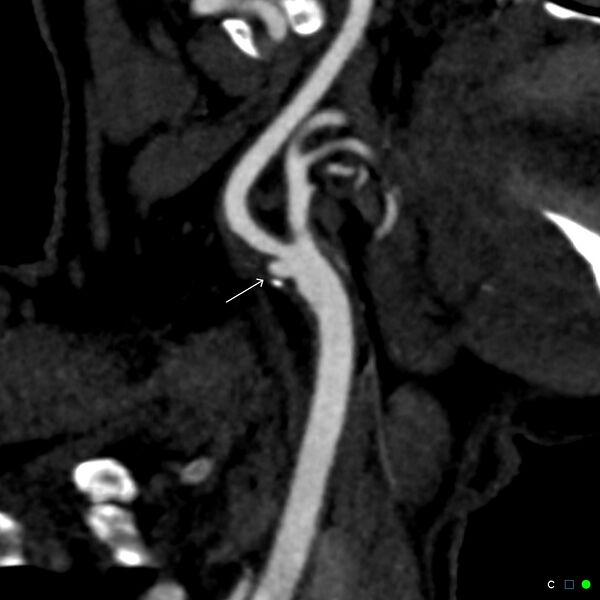 File:Non-occlusive intraluminal internal carotid artery thrombus (Radiopaedia 37751-39658 C 22).jpg
