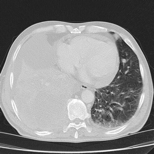 File:Non small-cell lung cancer (Radiopaedia 24467-24769 lung window 38).jpg