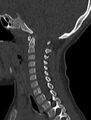 Normal CT cervical spine - pediatric (Radiopaedia 52549-58462 Sagittal bone window 122).jpg