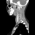 Normal CT of the neck (Radiopaedia 14575-14500 Sagittal C+ 17).jpg