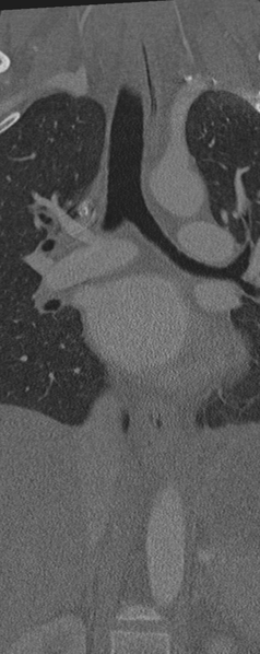 File:Normal CT thoracic spine (Radiopaedia 40181-42688 Coronal bone window 14).png