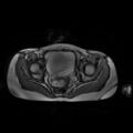Normal MRI abdomen in pregnancy (Radiopaedia 88001-104541 Axial Gradient Echo 51).jpg