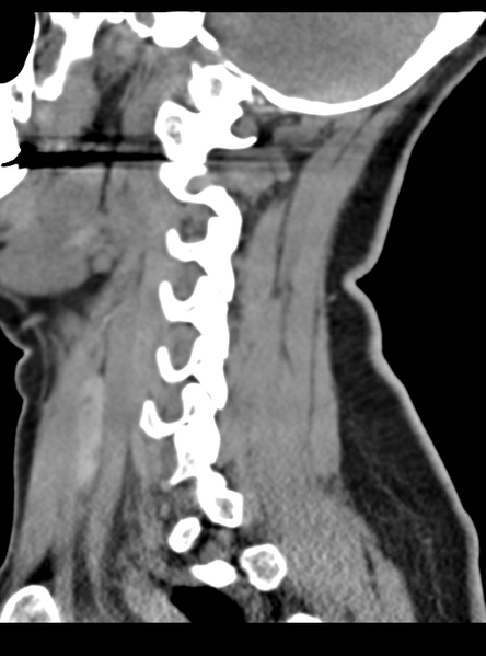 File:Normal cervical spine MRI (including Dixon) (Radiopaedia 42762-45926 C 17).png