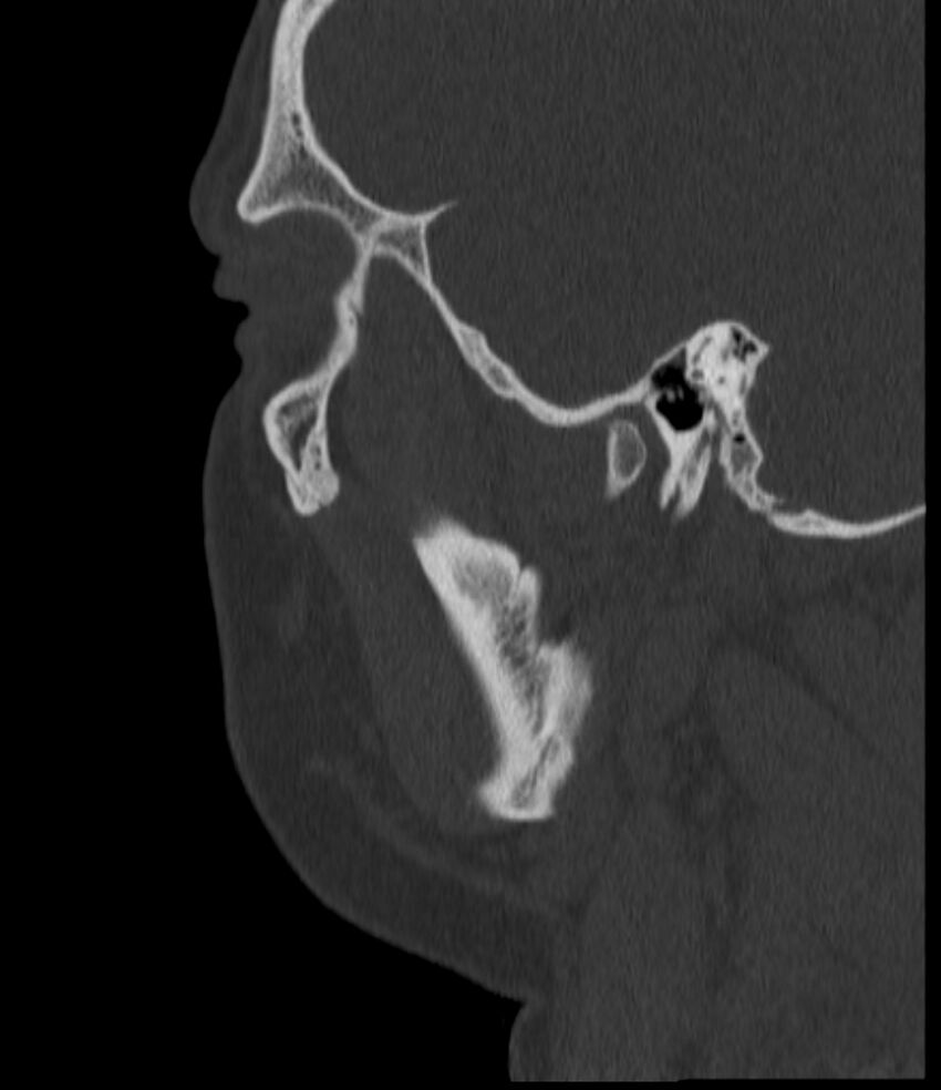 Normal facial bone CT (Radiopaedia 88742-105476 Sagittal bone window 130).jpg