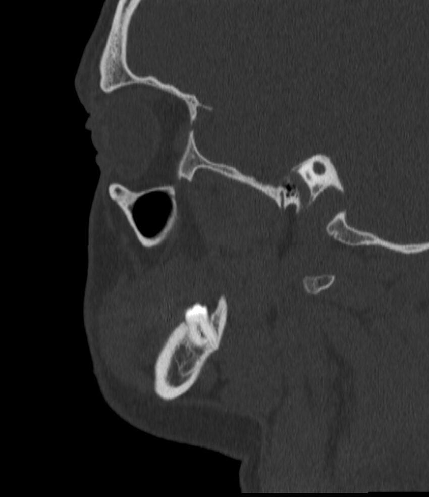 Normal facial bone CT (Radiopaedia 88742-105476 Sagittal bone window 53).jpg