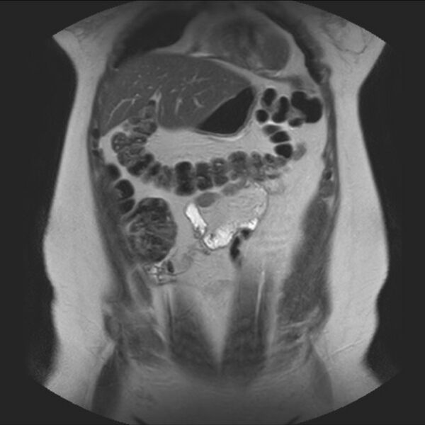 File:Normal liver MRI with Gadolinium (Radiopaedia 58913-66163 Coronal T2 12).jpg
