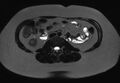 Normal liver MRI with Gadolinium (Radiopaedia 58913-66163 E 5).jpg