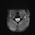 Normal trauma cervical spine (Radiopaedia 41017-43762 Axial T2 5).png